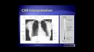 5 Steps to Chest Xray Interpretation [upl. by Thetisa]