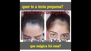 Minoxidil 3 meses ANTES E DEPOIS Funciona mesmo [upl. by Elleinahc677]