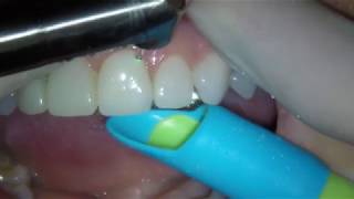 Laser removal of two eMax veneers with Fotona LightWalker ErYAG [upl. by Bove235]