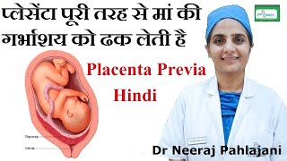 Placenta Previa होने के लक्षण इलाज और Low Lying Placenta से कैसे बचे [upl. by Conlan]