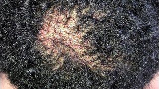 How To Cure Folliculitis Herbal Treatment at Home Remedy￼ The Fastest Way To Heal Folliculitis￼ [upl. by Filipe]