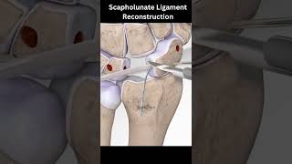 Scapholunate Ligament Reconstruction anatomyexplained 3danimation [upl. by Gonta]