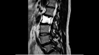 rare case of hemangioma L2 L3 [upl. by Erie647]