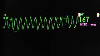 ventricular tachycardia  Torsade de Pointes on an ECG heart monitor [upl. by Nolram]