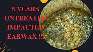 5 YEARS Untreated Impacted Earwax Very Satisfying Result [upl. by Aeynod663]