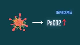 Hypercapnia Pathophysiology Of CO2 Retention [upl. by Aivon619]