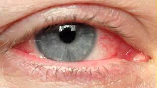 Eye cancer symptoms [upl. by Notsnarc346]