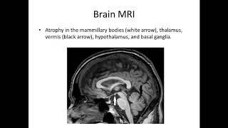 Korsakoff syndrome of psychiatric and alcoholic etiology  Video abstract ID 203513 [upl. by Aloisia829]