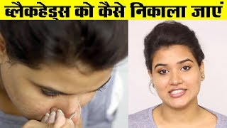 How to Remove Blackheads from Nose  Face Hindi [upl. by Etteiram]