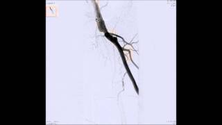 Ostial SFA ISR treated with Balloon angioplasty [upl. by Munro]