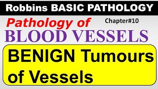 Ch10  Benign Tumours of Vessels  Blood Vessel Pathology  Robbins Lectures [upl. by Doralynne]