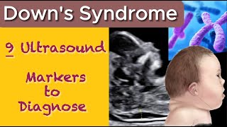 Downs Syndrome  9 Ultrasound Markers to Diagnose Abnormalities in Baby [upl. by Alliuqat]