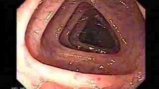 Endoscopia del Colon Colonoscopia [upl. by Pell]