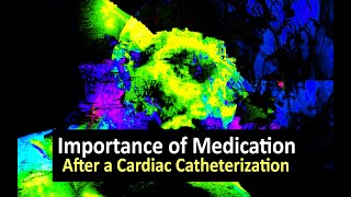 Importance of Medication After a Cardiac Catheterization [upl. by Yvan]