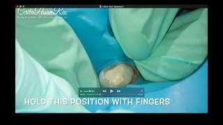 SINGLE TOOTH ISOLATION with Rubber dam in ENdodontic Treatment [upl. by Adihahs454]