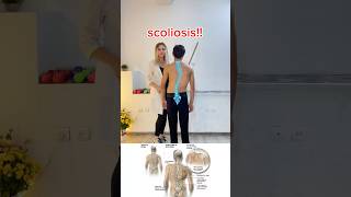 Got scoliosis Try these exercises to help correct your spine httpsverginiacentercom [upl. by Hefter]