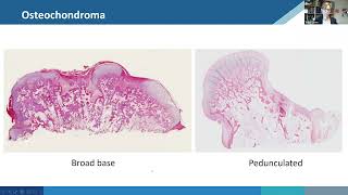 Chondrogenic tumors of bone [upl. by Georgena]