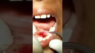 sublingual mucocele Ranula treated by Laser by DrCParya MDS Dip in Laser [upl. by Feil]