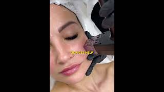 Does RF microneedling Help with Large Pores shrinkpores skin acnescars Honest2234 [upl. by Oremor]