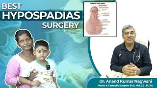 Hypospadias  প্রস্রাব সঠিক জায়গায় না খোলার সমস্যা  Hypospadias Repair in India  Dr Nagwani [upl. by Helve338]