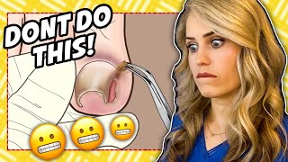 Doctor reacts Ingrown nail gone wrong [upl. by Shirleen485]