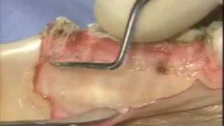 Introductory Periodontal Surgical Techniques The Apically Positioned Flap and Crown Lengthening [upl. by Benjamen]