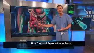 How Typhoid Fever Affects the Body  The Doctors [upl. by Lartnom]