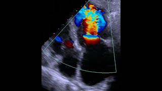 Mitral stenosis Overview and common causes [upl. by Stagg]