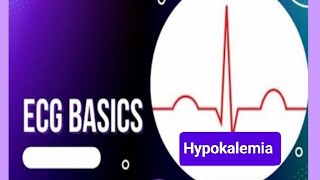 ECG changes in Hypokalemia Causes of Hypokalemia [upl. by Aiek]