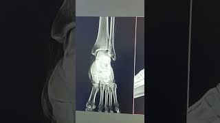 X ray foot aplat [upl. by Ramah]