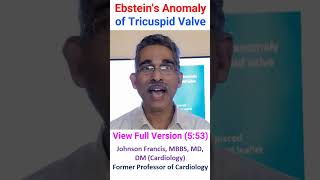 Ebsteins Anomaly of Tricuspid Valve [upl. by Aztiraj91]