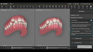 Carriere Motion Appliance Prior to Invisalign [upl. by Mita]