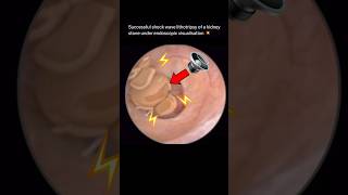 Shock Wave Lithotripsy BREAKS DOWN Kidney Stone endoscopic visualization [upl. by Suaeddaht622]