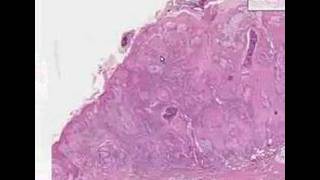 Histopathology Skin Squamous cell carcinoma [upl. by Dnalyag]