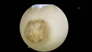 All Arthroscopic Osteochondral Autograft Transplantation for Medial Talar Dome Lesions Talus [upl. by Windy]