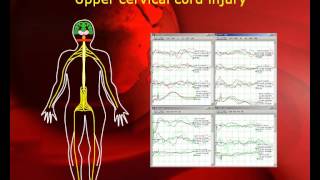 quotPatient Transparentquot Intraoperative Neurophysiological Monitoring in MISS [upl. by Cirtap]