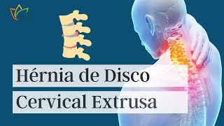 Hérnia de Disco Cervical Extrusa [upl. by Eadwina]