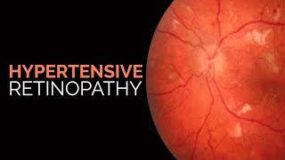 Hypertensive Retinopathy  Stages  KeithWagenerBarker classification [upl. by Nilpik375]