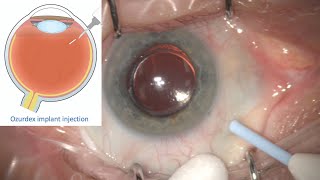 Ozurdex Implant Intravitreal Eye injection for Treatment of Retinal Oedema and Inflammation [upl. by Veronica]