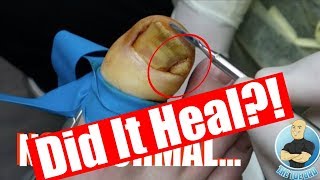 DID IT HEAL INFECETED INGROWN TOENAIL FOLLOWUP [upl. by Nho988]