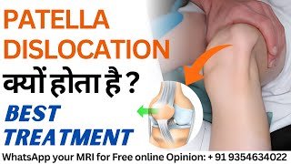 Patella Subluxation Dislocation क्यों होता है  MPFL Injury Causes amp Best Treatment [upl. by Hoi]