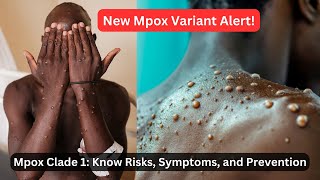 Mpox VARIANT ALERT What You Need to Know About Clade 1 Risks and Prevention [upl. by Ahsekad]