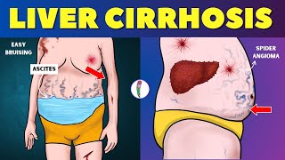 Liver cirrhosis  Warning Signs 🔥 Dont ignore these Red Flags  Chronic Liver Disease  Fatty Liver [upl. by Rickart]