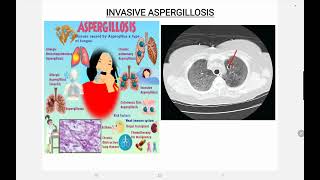 Invasive Aspergillosis [upl. by Enaid67]