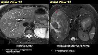 Liver MRI Normal Vs Hepatocellular Carcinoma HCC Images  T1 T2 DWI ADC amp Contrast Sequences [upl. by Sewellyn]