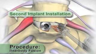 Medical Animation Lumbar Interbody Fusionflv [upl. by Odlamur]