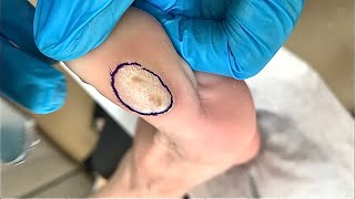 Callus removal from feetampFoot scraping dead skin【Xiao Yan pedicure】stress 117 [upl. by Schluter]