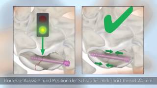 HBS 2 – Minimalinvasive palmare OPTechnik [upl. by Aynotal]