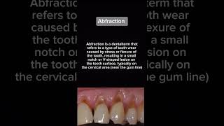 Abfraction  Dental Anomaly  Oral Biology  Dental School [upl. by Genny671]