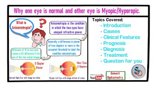 Why one eye is normal and other is Myopic or Hyperopic Simple Anisometropia [upl. by Talyah459]